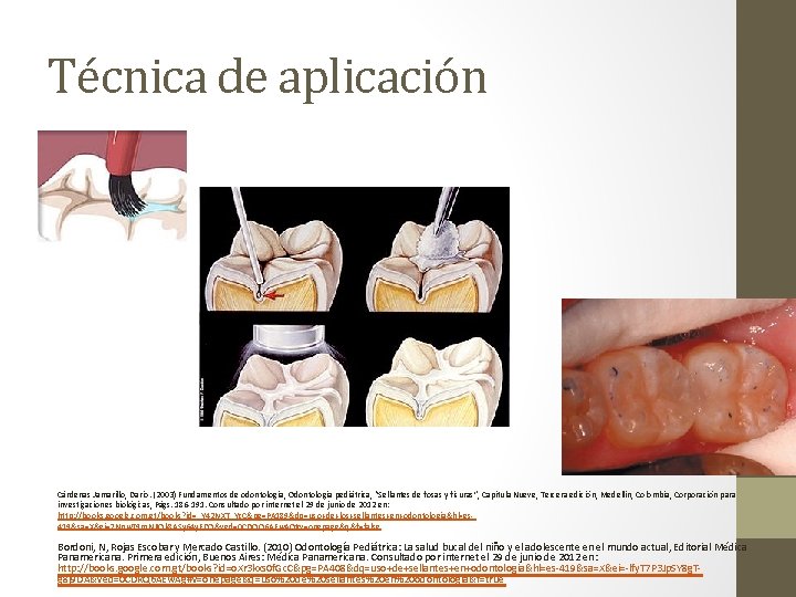 Técnica de aplicación Cárdenas Jamarillo, Darío. (2003) Fundamentos de odontología, Odontología pediátrica, “Sellantes de