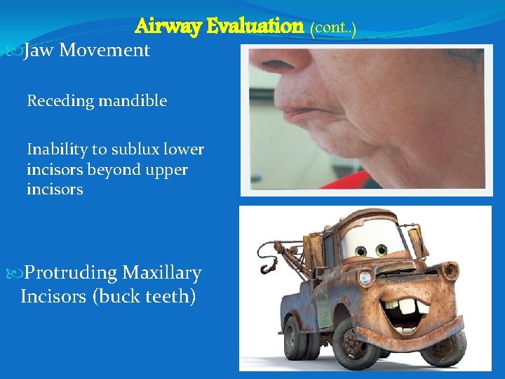 Airway Evaluation (cont. . ) Jaw Movement Receding mandible Inability to sublux lower incisors