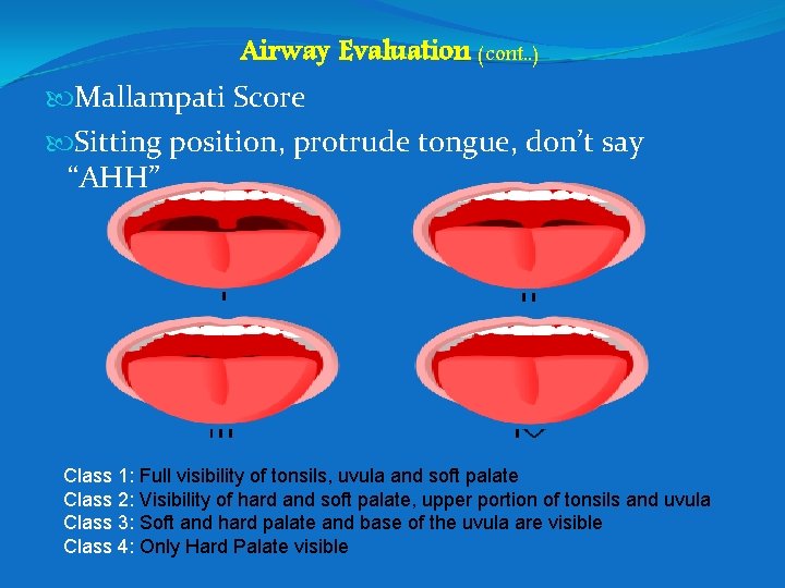 Airway Evaluation (cont. . ) Mallampati Score Sitting position, protrude tongue, don’t say “AHH”