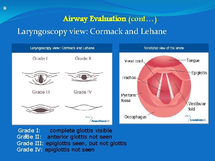 Airway Evaluation (cont…) Laryngoscopy view: Cormack and Lehane Grade I: complete glottis visible Grade