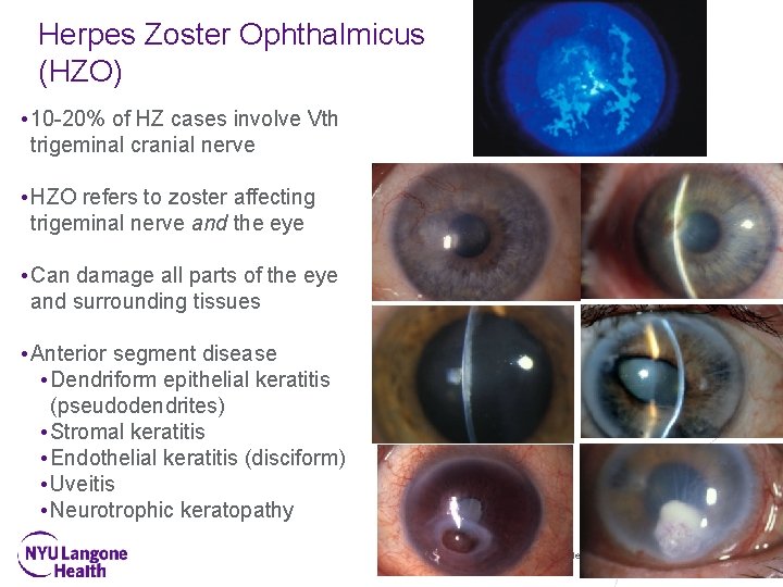Herpes Zoster Ophthalmicus (HZO) • 10 -20% of HZ cases involve Vth trigeminal cranial