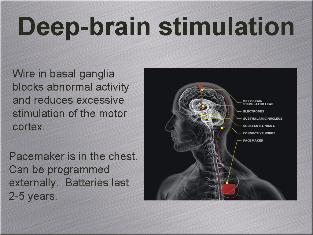 Deep-brain stimulation Wire in basal ganglia blocks abnormal activity and reduces excessive stimulation of