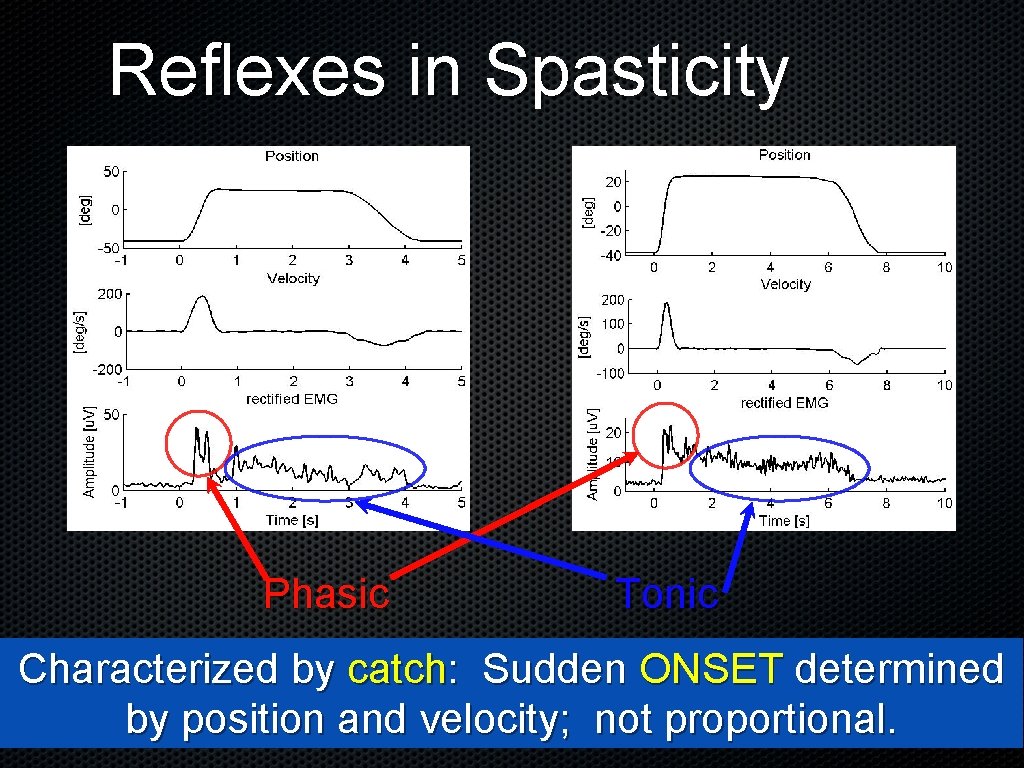 Reflexes in Spasticity Phasic Tonic Characterized by catch: Sudden ONSET determined by position and