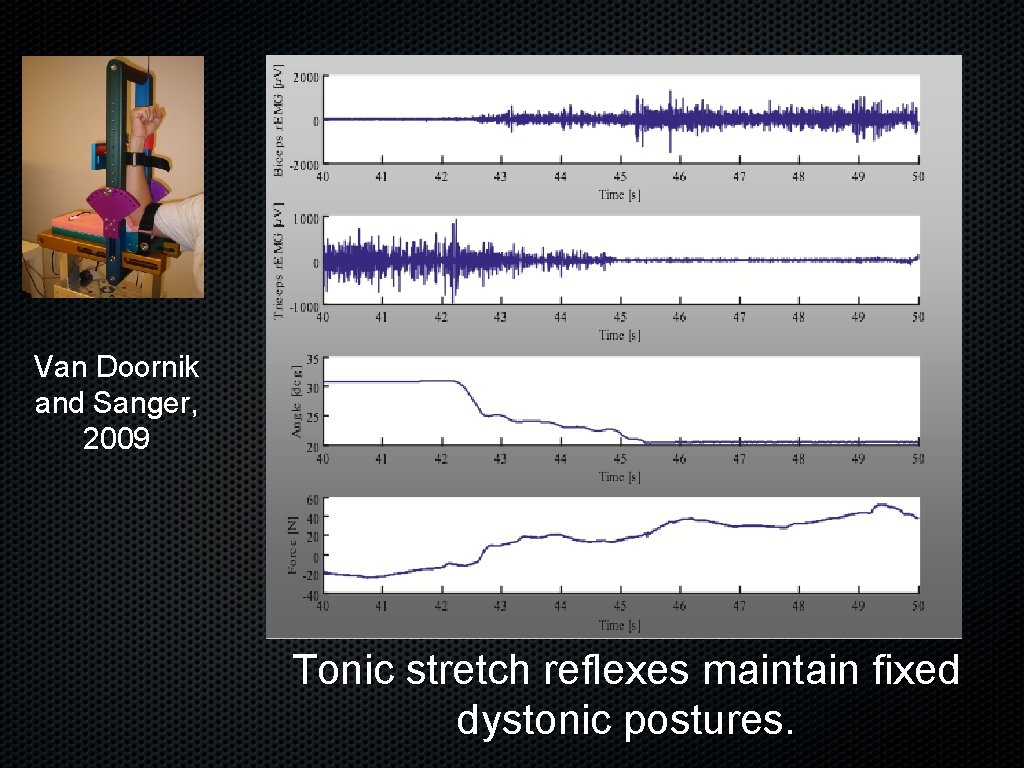 Van Doornik and Sanger, 2009 Tonic stretch reflexes maintain fixed dystonic postures. 