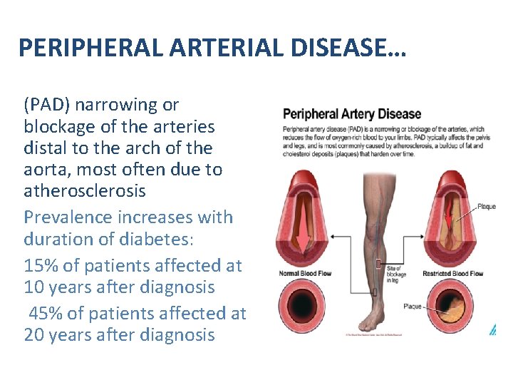 PERIPHERAL ARTERIAL DISEASE… (PAD) narrowing or blockage of the arteries distal to the arch