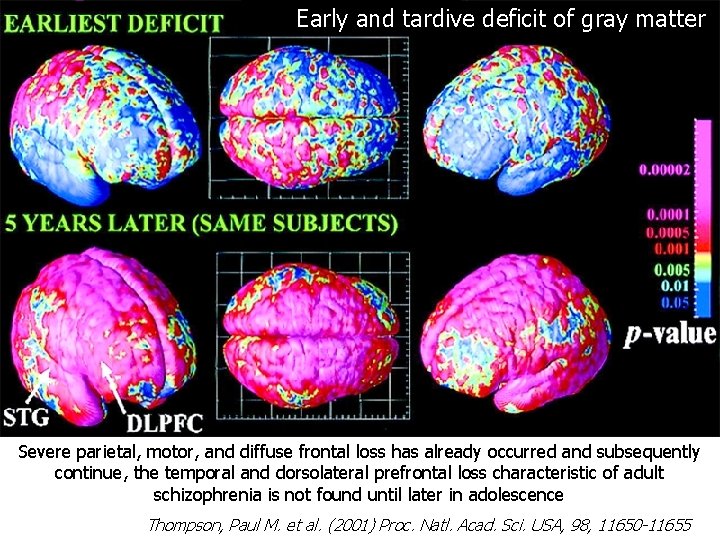 Early and tardive deficit of gray matter Severe parietal, motor, and diffuse frontal loss