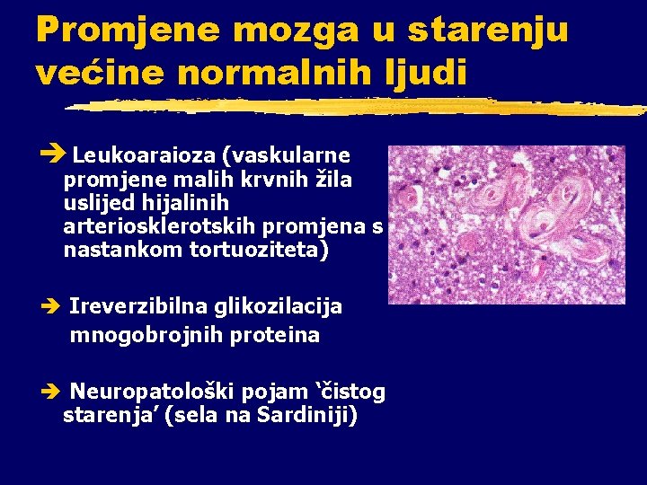 Promjene mozga u starenju većine normalnih ljudi è Leukoaraioza (vaskularne promjene malih krvnih žila