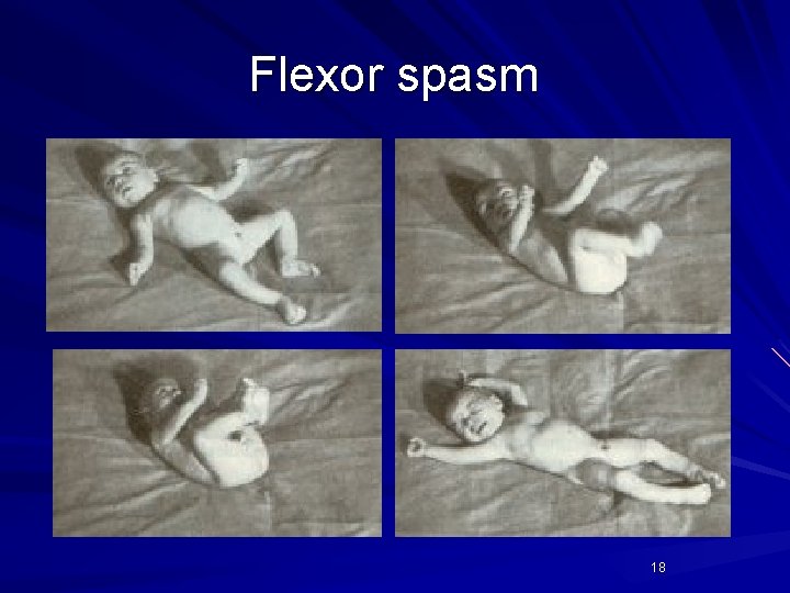 Flexor spasm 18 Flexor spasm 18