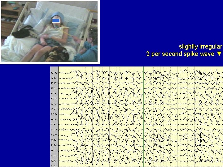 slightly irregular 3 per second spike wave ▼ 