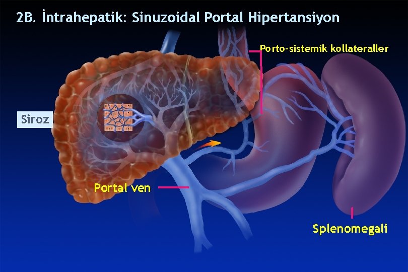 SINUSOIDALPORTALHYPERTENSION 2 B. İntrahepatik: Sinuzoidal Portal Hipertansiyon Porto-sistemik kollateraller Siroz Portal ven Splenomegali SINUSOIDALPORTALHYPERTENSION 2 B. İntrahepatik: Sinuzoidal Portal Hipertansiyon Porto-sistemik kollateraller Siroz Portal ven Splenomegali