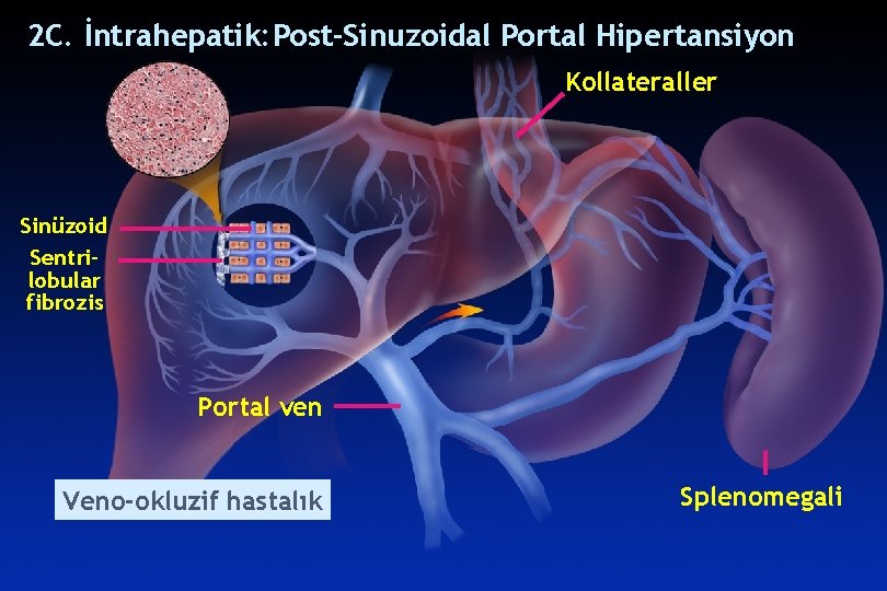 POST-SINUSOIDALPORTALHYPERTENSION 2 C. İntrahepatik: Post-Sinuzoidal Portal Hipertansiyon Kollateraller Sinüzoid Sentrilobular fibrozis Portal ven Veno-okluzif POST-SINUSOIDALPORTALHYPERTENSION 2 C. İntrahepatik: Post-Sinuzoidal Portal Hipertansiyon Kollateraller Sinüzoid Sentrilobular fibrozis Portal ven Veno-okluzif