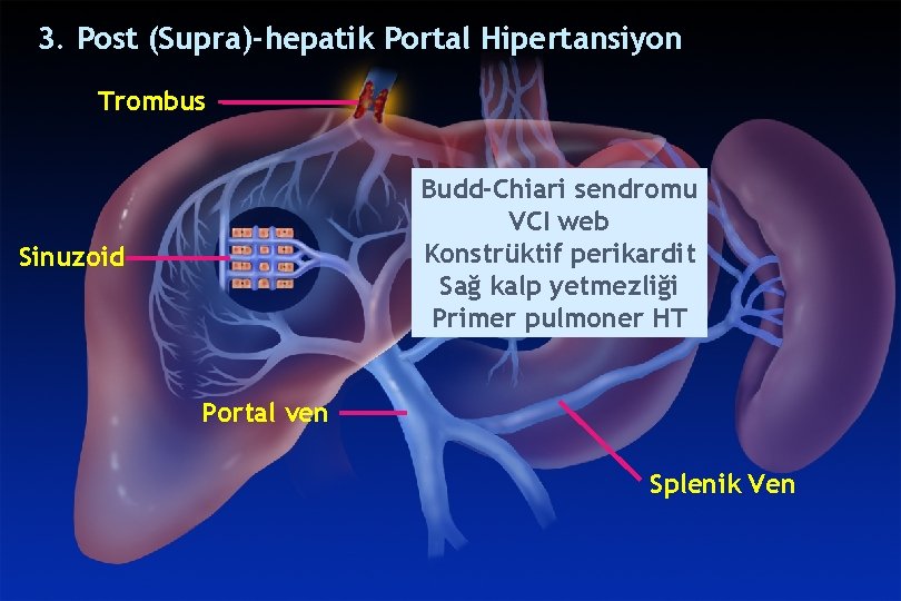 POST-HEPATICPORTALHYPERTENSION 3. Post (Supra)-hepatik Portal Hipertansiyon Trombus Budd-Chiari sendromu VCI web Konstrüktif perikardit Sağ POST-HEPATICPORTALHYPERTENSION 3. Post (Supra)-hepatik Portal Hipertansiyon Trombus Budd-Chiari sendromu VCI web Konstrüktif perikardit Sağ