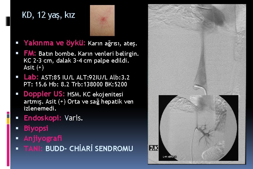 KD, 12 yaş, kız Yakınma ve öykü: Karın ağrısı, ateş. FM: Batın bombe. Karın KD, 12 yaş, kız Yakınma ve öykü: Karın ağrısı, ateş. FM: Batın bombe. Karın