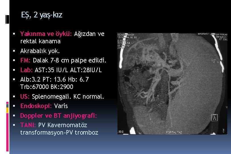 EŞ, 2 yaş-kız Yakınma ve öykü: Ağızdan ve rektal kanama Akrabalık yok. FM: Dalak EŞ, 2 yaş-kız Yakınma ve öykü: Ağızdan ve rektal kanama Akrabalık yok. FM: Dalak
