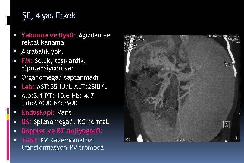 ŞE, 4 yaş-Erkek Yakınma ve öykü: Ağızdan ve rektal kanama Akrabalık yok. FM: Soluk, ŞE, 4 yaş-Erkek Yakınma ve öykü: Ağızdan ve rektal kanama Akrabalık yok. FM: Soluk,
