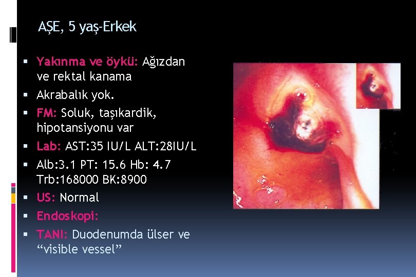 AŞE, 5 yaş-Erkek Yakınma ve öykü: Ağızdan ve rektal kanama Akrabalık yok. FM: Soluk, AŞE, 5 yaş-Erkek Yakınma ve öykü: Ağızdan ve rektal kanama Akrabalık yok. FM: Soluk,