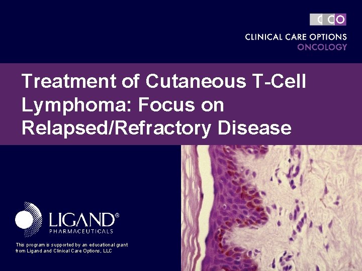 Treatment of Cutaneous T-Cell Lymphoma: Focus on Relapsed/Refractory Disease This program is supported by