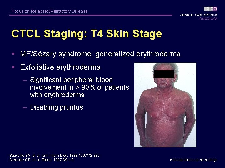 Focus on Relapsed/Refractory Disease CTCL Staging: T 4 Skin Stage § MF/Sézary syndrome; generalized