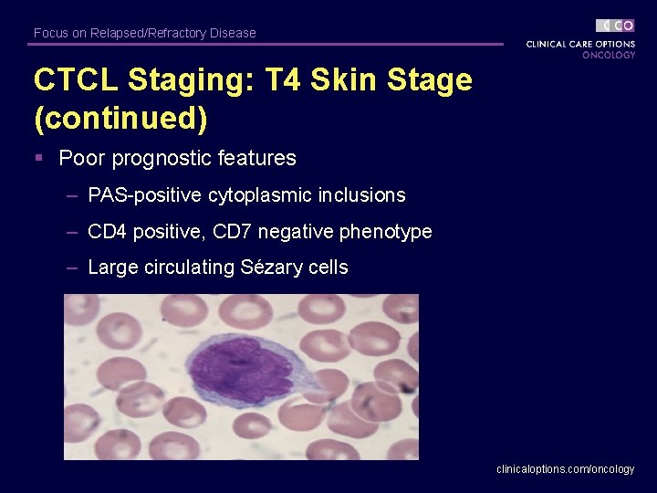 Focus on Relapsed/Refractory Disease CTCL Staging: T 4 Skin Stage (continued) § Poor prognostic