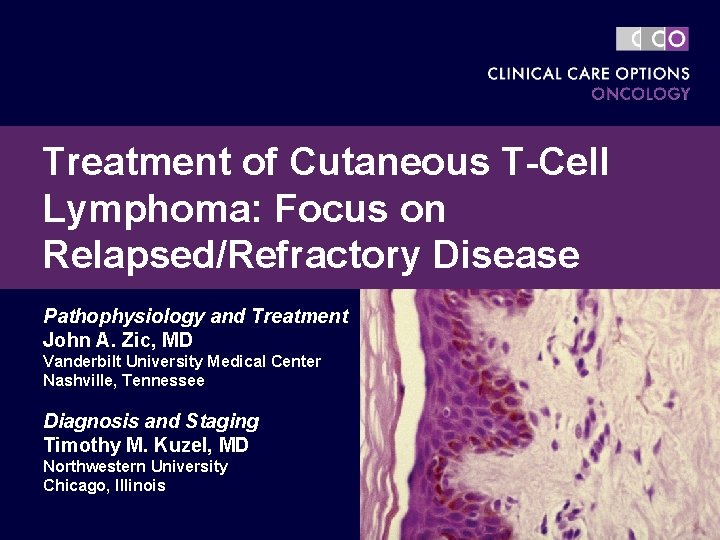 Treatment of Cutaneous T-Cell Lymphoma: Focus on Relapsed/Refractory Disease Pathophysiology and Treatment John A.