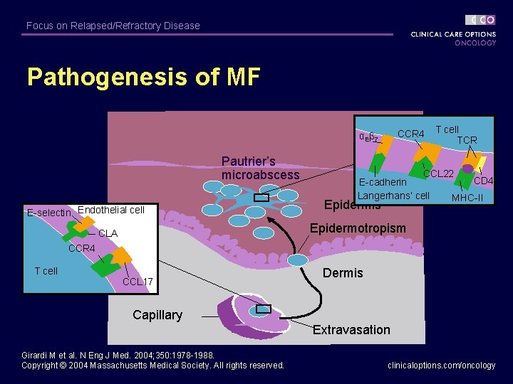 Focus on Relapsed/Refractory Disease Pathogenesis of MF CCR 4 αEβ 7 Pautrier’s microabscess E-selectin
