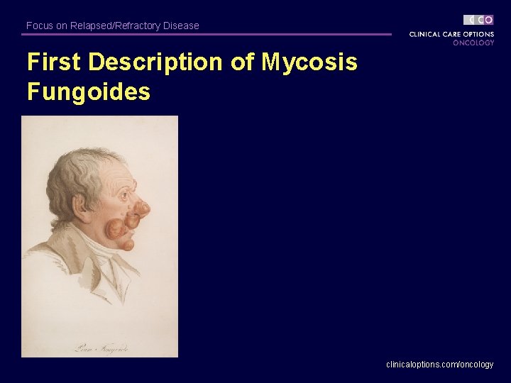 Focus on Relapsed/Refractory Disease First Description of Mycosis Fungoides clinicaloptions. com/oncology 