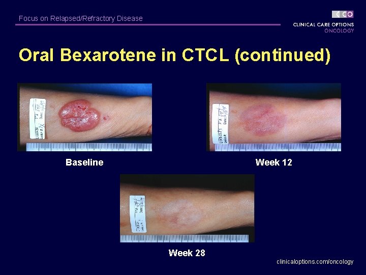 Focus on Relapsed/Refractory Disease Oral Bexarotene in CTCL (continued) Baseline Week 12 Week 28