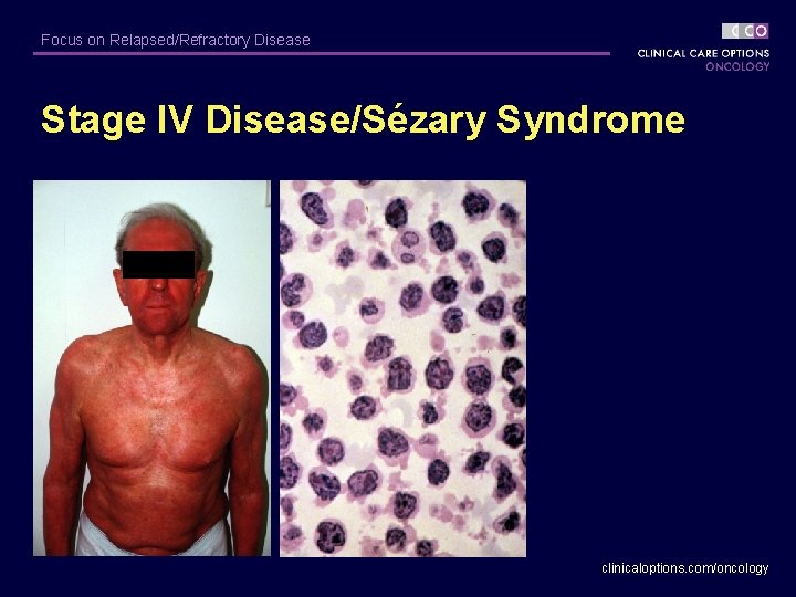 Focus on Relapsed/Refractory Disease Stage IV Disease/Sézary Syndrome clinicaloptions. com/oncology 