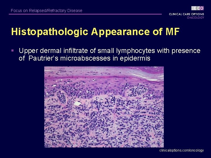 Focus on Relapsed/Refractory Disease Histopathologic Appearance of MF § Upper dermal infiltrate of small