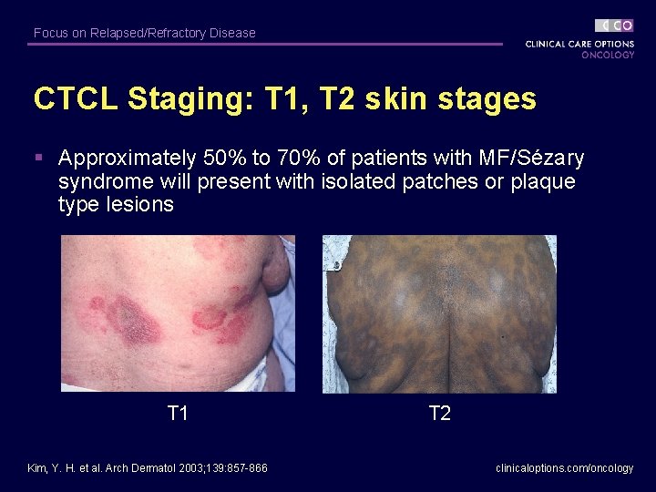 Focus on Relapsed/Refractory Disease CTCL Staging: T 1, T 2 skin stages § Approximately