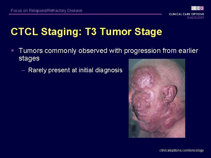 Focus on Relapsed/Refractory Disease CTCL Staging: T 3 Tumor Stage § Tumors commonly observed