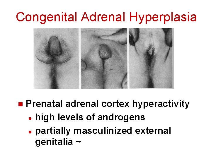 Congenital Adrenal Hyperplasia n Prenatal adrenal cortex hyperactivity l high levels of androgens l