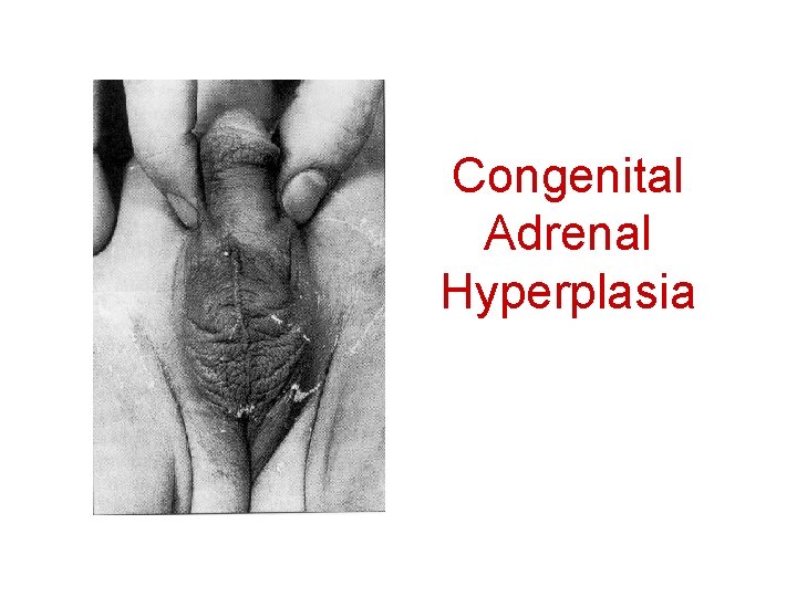 Congenital Adrenal Hyperplasia 