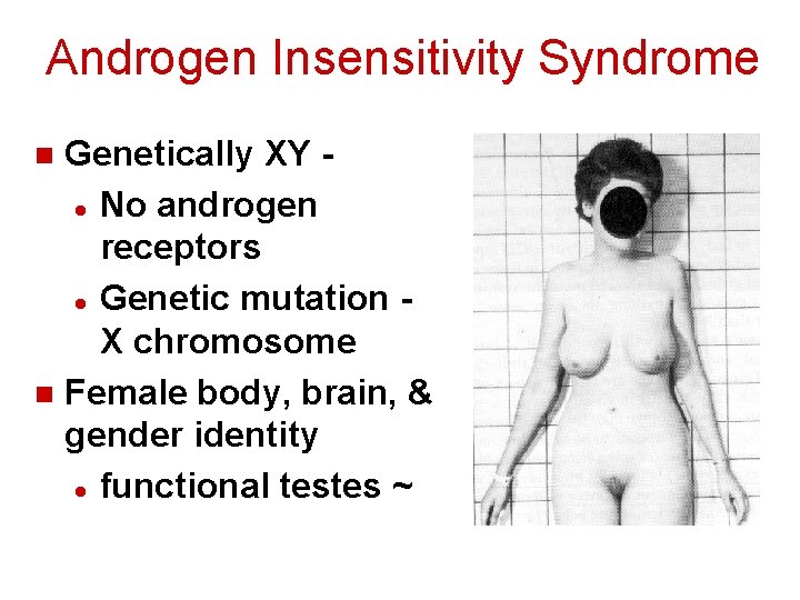 Androgen Insensitivity Syndrome Genetically XY l No androgen receptors l Genetic mutation X chromosome