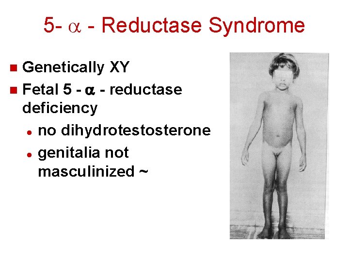 5 - a - Reductase Syndrome Genetically XY n Fetal 5 - a -