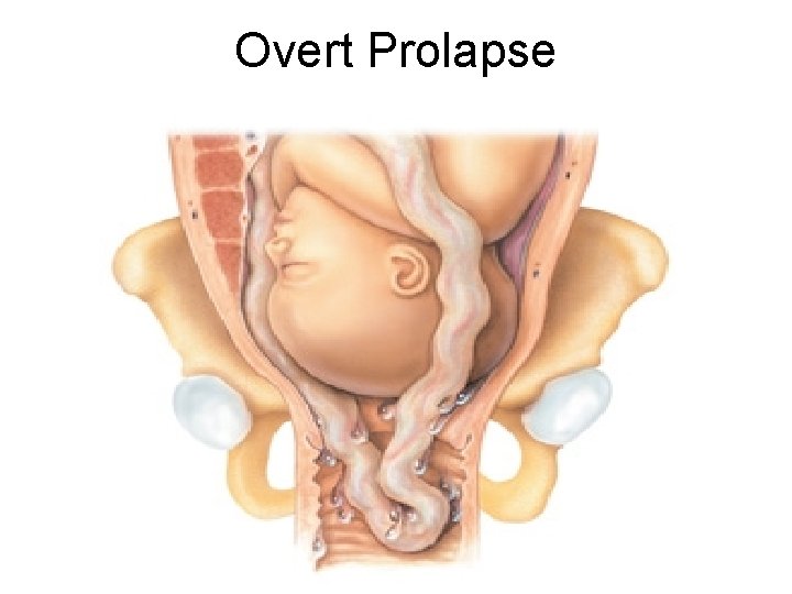 Overt Prolapse 