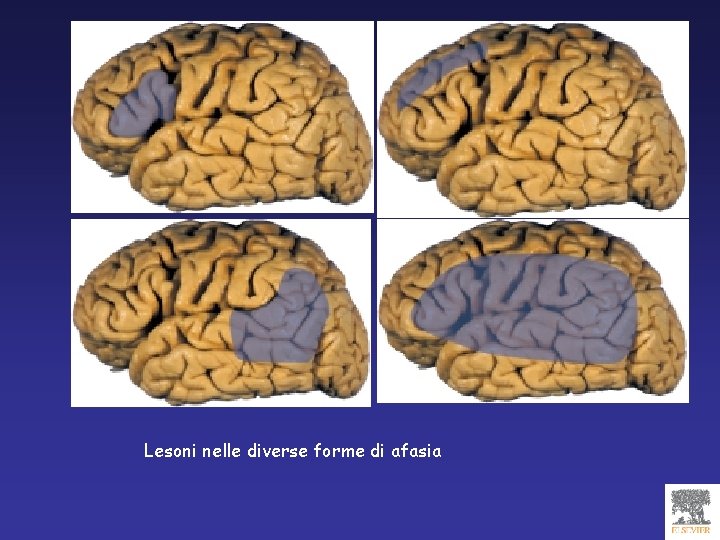 Lesoni nelle diverse forme di afasia 