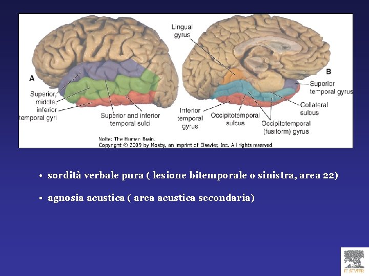  • sordità verbale pura ( lesione bitemporale o sinistra, area 22) • agnosia