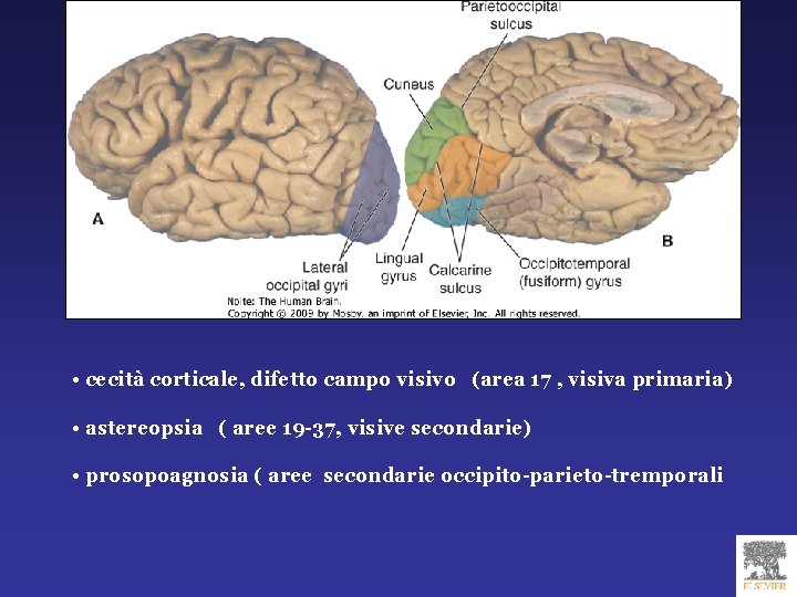  • cecità corticale, difetto campo visivo (area 17 , visiva primaria) • astereopsia