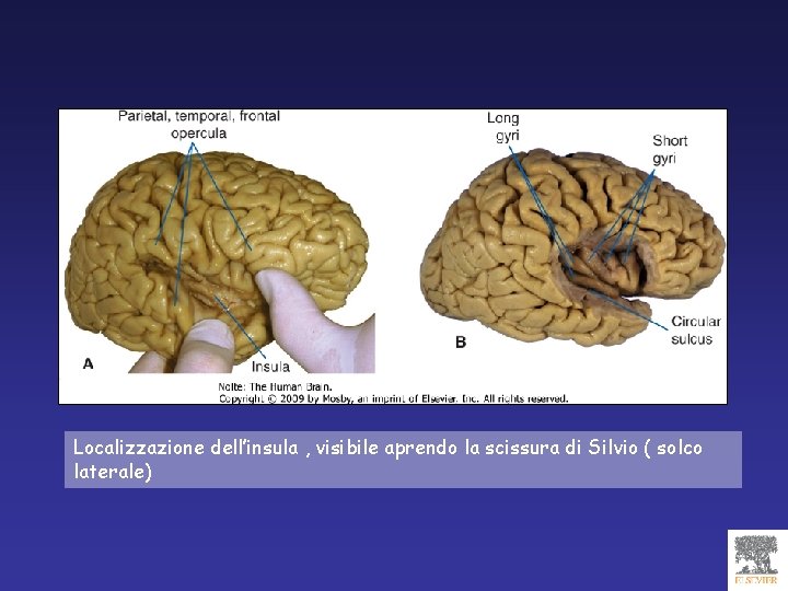 Localizzazione dell’insula , visibile aprendo la scissura di Silvio ( solco laterale) 