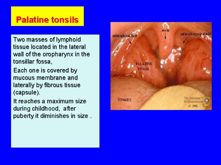 Palatine tonsils Two masses of lymphoid tissue located in the lateral wall of the