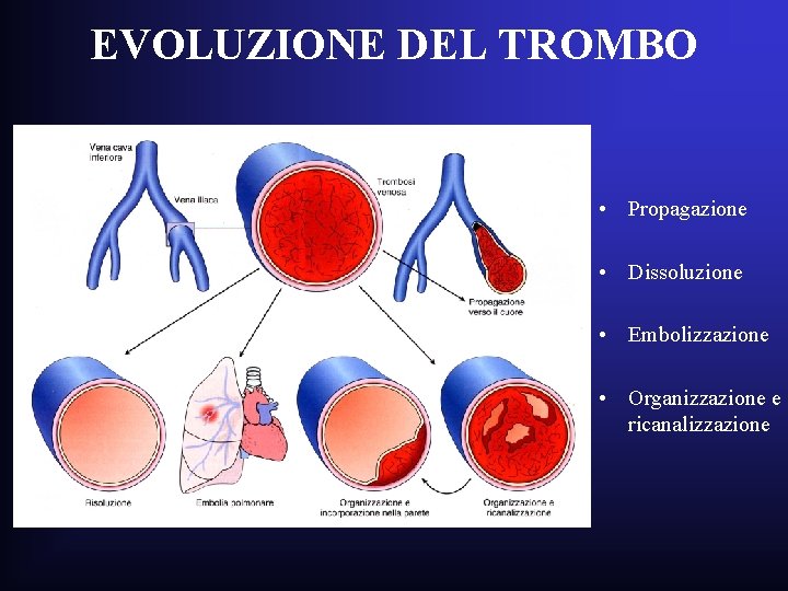 EVOLUZIONE DEL TROMBO • Propagazione • Dissoluzione • Embolizzazione • Organizzazione e ricanalizzazione EVOLUZIONE DEL TROMBO • Propagazione • Dissoluzione • Embolizzazione • Organizzazione e ricanalizzazione