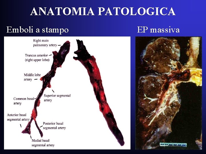 ANATOMIA PATOLOGICA Emboli a stampo EP massiva ANATOMIA PATOLOGICA Emboli a stampo EP massiva