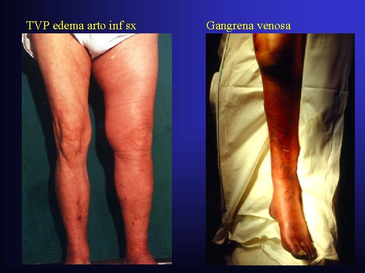 TVP edema arto inf sx Gangrena venosa TVP edema arto inf sx Gangrena venosa