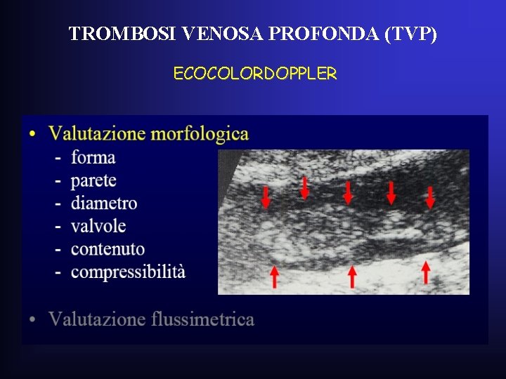 TROMBOSI VENOSA PROFONDA (TVP) ECOCOLORDOPPLER TROMBOSI VENOSA PROFONDA (TVP) ECOCOLORDOPPLER