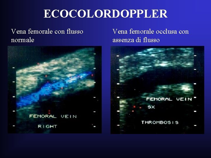ECOCOLORDOPPLER Vena femorale con flusso normale Vena femorale occlusa con assenza di flusso ECOCOLORDOPPLER Vena femorale con flusso normale Vena femorale occlusa con assenza di flusso