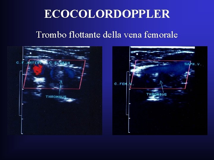 ECOCOLORDOPPLER Trombo flottante della vena femorale ECOCOLORDOPPLER Trombo flottante della vena femorale