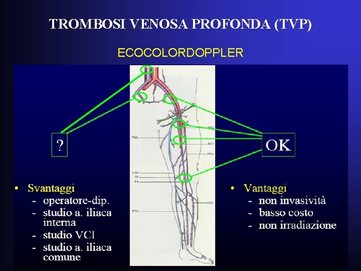TROMBOSI VENOSA PROFONDA (TVP) ECOCOLORDOPPLER TROMBOSI VENOSA PROFONDA (TVP) ECOCOLORDOPPLER