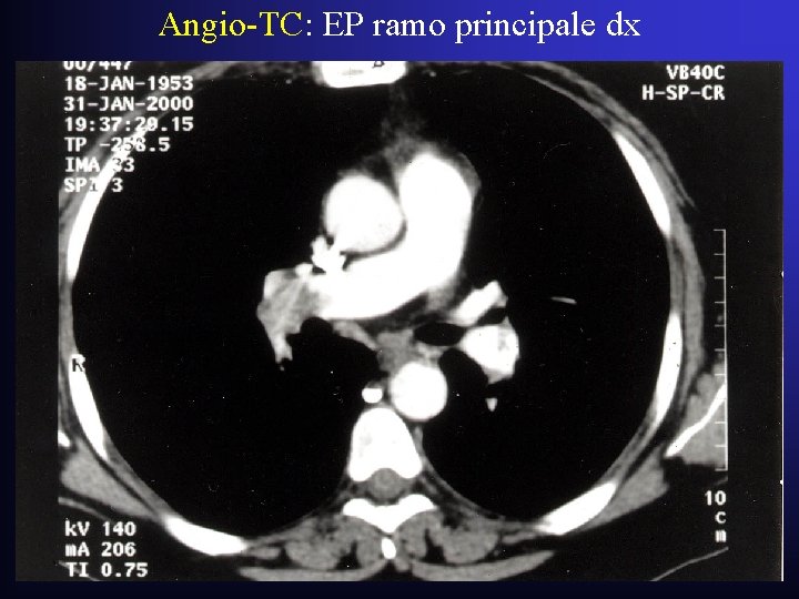 Angio-TC: EP ramo principale dx Angio-TC: EP ramo principale dx