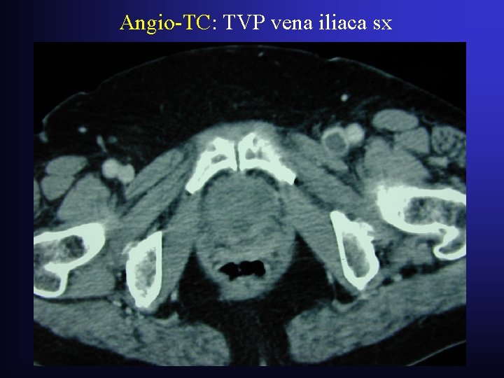 Angio-TC: TVP vena iliaca sx Angio-TC: TVP vena iliaca sx